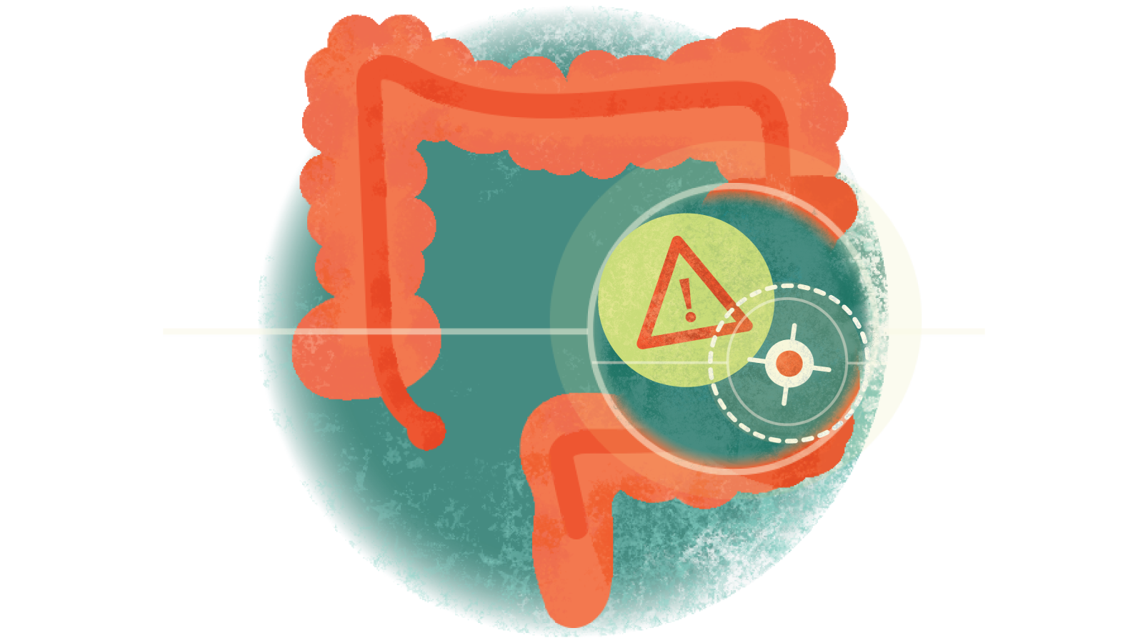 Illustration of a compass with an exclamation point inside a triangle over a colon with ulcerative colitis 