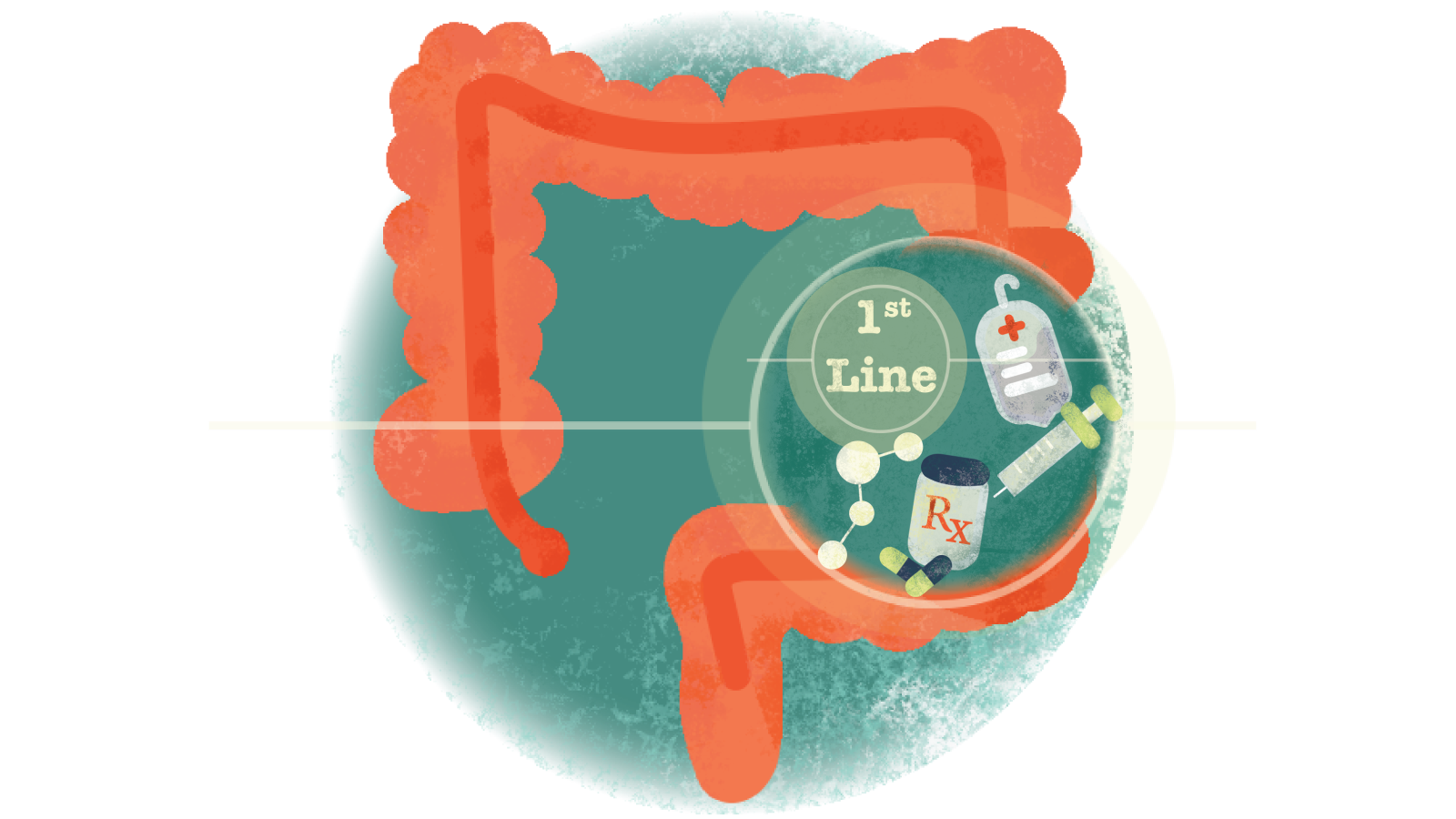 Illustration of pills, syringe, IV bag with text 1st in a circle over a colon with ulcerative colitis 